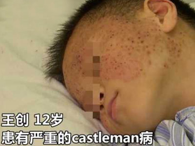 男孩生怪病皮膚如蟾蜍