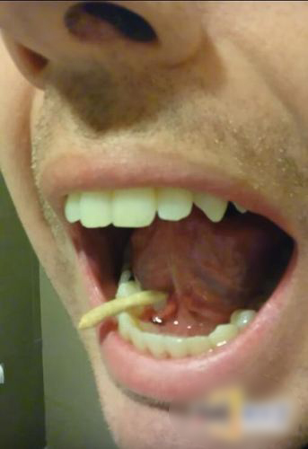 口腔不适看医生 男子舌下拔出3cm超长怪虫