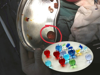 男童誤食水寶寶誘發(fā)機(jī)械性腸梗阻
