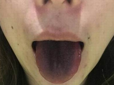 女子吃火锅舌头变黑 女子吃火锅舌头变黑