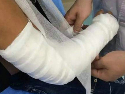 學生被老師推骨折 