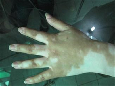 白癜风啥样的症状比较明显