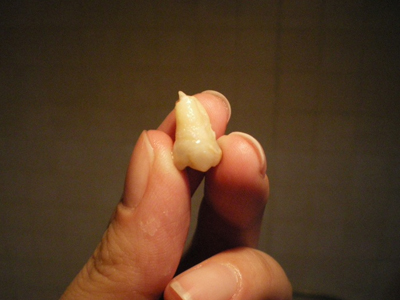 下牙疼被拔掉上牙 下牙疼被拔掉上牙