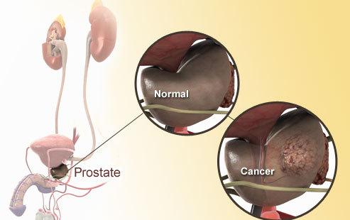 什么是前列腺癌