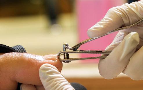 乙肝丙肝的危险源：修脚、剪指甲和理发