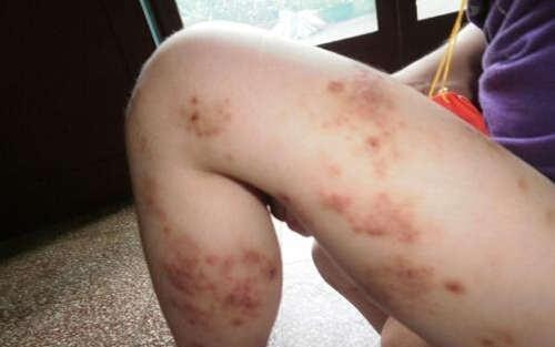 治湿疹的药 治湿疹的药