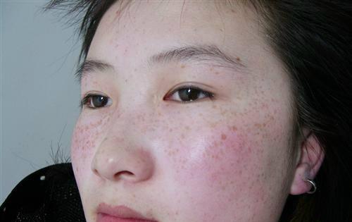 汗斑怎么治疗 汗斑怎么治疗