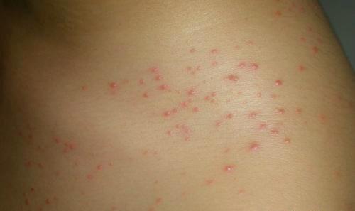 猩红热传染吗 猩红热传染吗