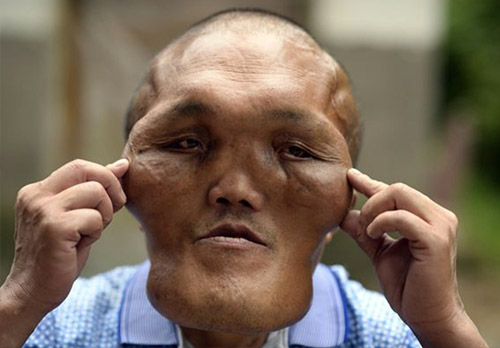 男子患怪病面部增大似外星人