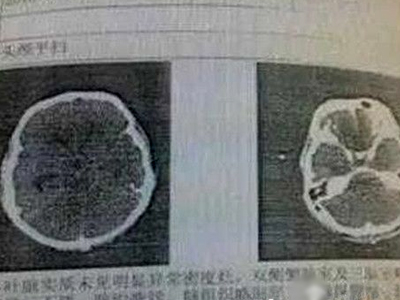 食脑虫是什么