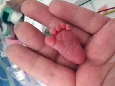 世界最袖珍婴儿出生近277克 新生儿体重影响因素