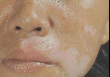 白癜风的病发可以在任何部位,脸上也是每个部位都可能会患上的,而脸上