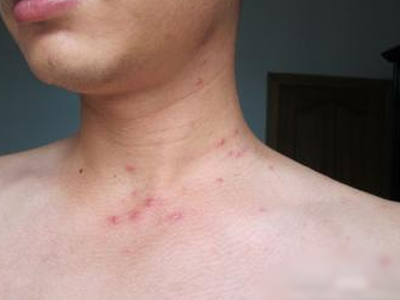 每万人中6人染艾滋