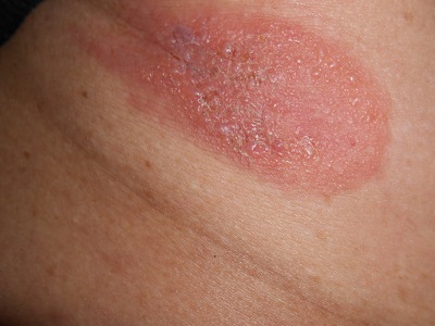 白癜风复发后怎么办?