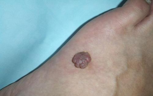 瘊子的最佳治疗方法(2)