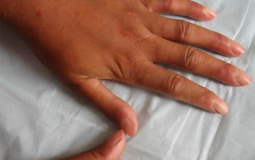 患有硬皮病严重吗(1)