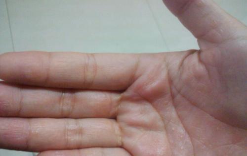 当手指上起了水泡的时候，我们该怎么办？