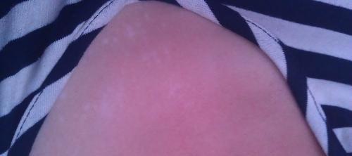 胸前有白点怎么回事呢(1)