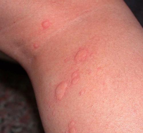 胆碱性荨麻疹初期症状图片