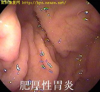胃炎图片