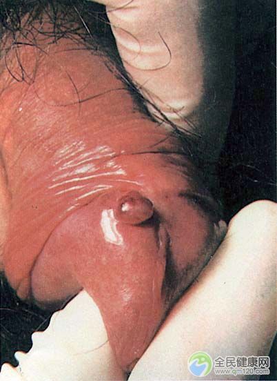 艾滋病