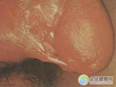 硬下疳疾病