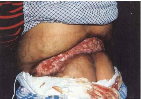 盘腰毒