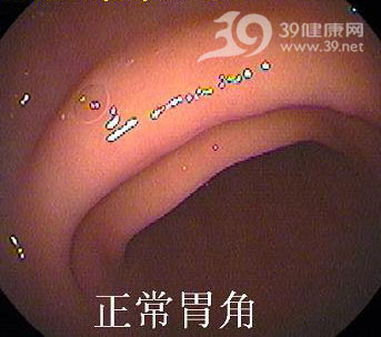 正常胃底