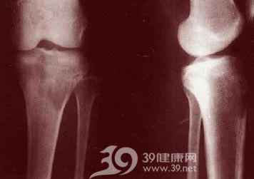 骨的恶性淋巴瘤